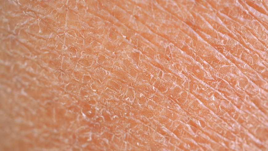 Iktyos kännetecknas av torr, sträv, förtjockad och/eller fjällig hud. Foto: Shutterstock