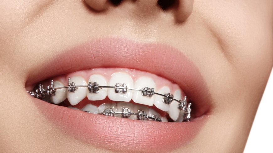 Tandställning är en vanlig form av tandreglering. Foto: Shutterstock