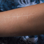 Underarmsfraktur: symtom, orsaker & behandling