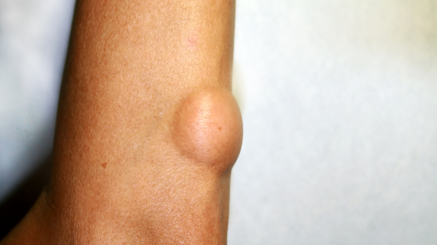 Underarmen och armbågen är vanliga platser för fettknölar. Foto: Getty Images