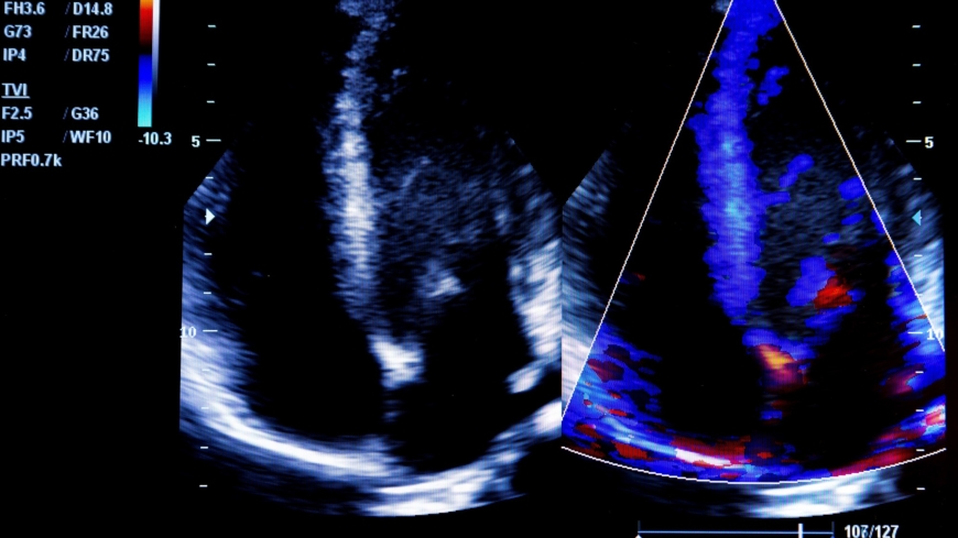 Enkammarhjärta brukar ofta upptäckas vid ultraljudsundersökningar. Foto: Shutterstock
