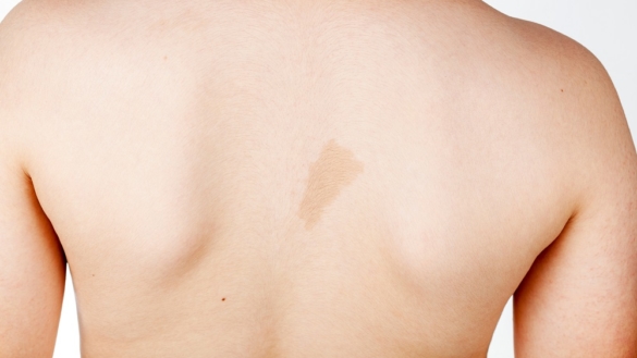 Neurofibromatos (NF): symtom, orsaker & behandling