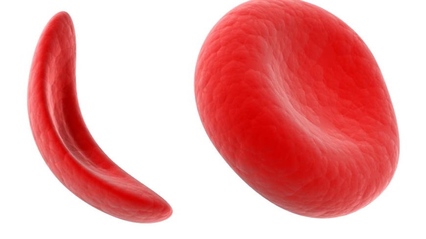 Röda blodkroppar med (vänster) och utan (höger) sicklecellanemi. Foto: Shutterstock
