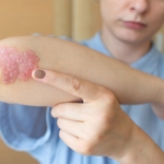 Psoriasis