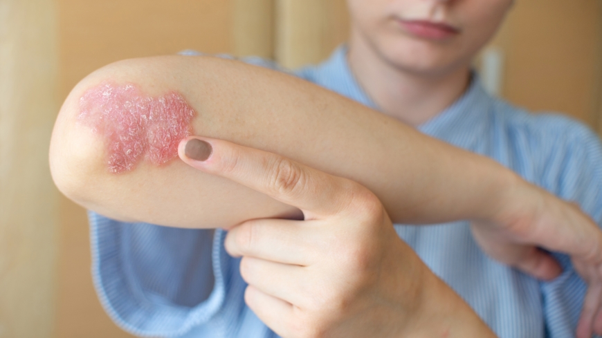 Psoriasis