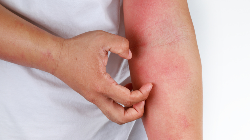 Atopisk dermatit