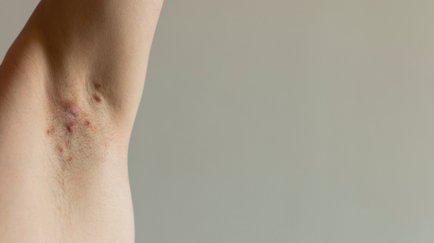 Hidradenitis suppurativa