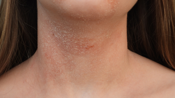 Atopisk dermatit – frågor och svar