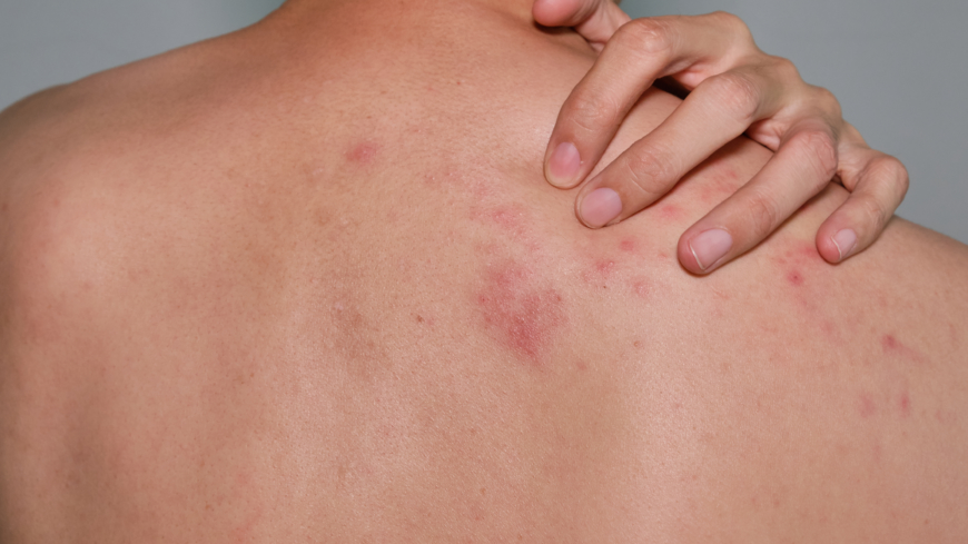 Bältros kan drabba alla och vissa får allvarliga komplikationer och svår smärta. Foto: Shutterstock