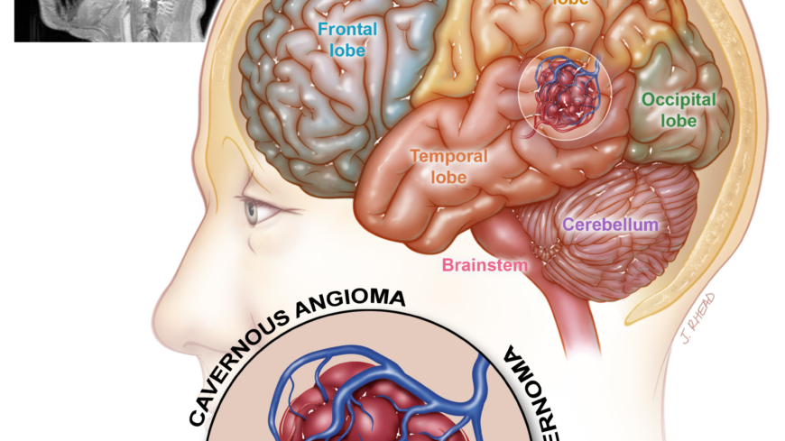 Ett kavernom, även kallat cavernöst angiom, är en kärlmissbildning som kan finnas i hjärnan eller i ryggmärgen Foto: Angioma Alliance
