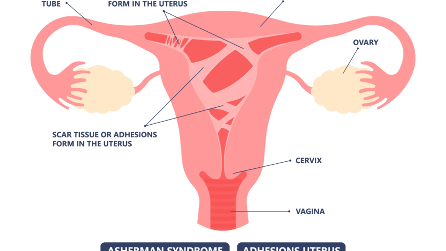 Ashermans syndrom innebär ärrvävnad inne i livmodern. Foto: Shutterstock