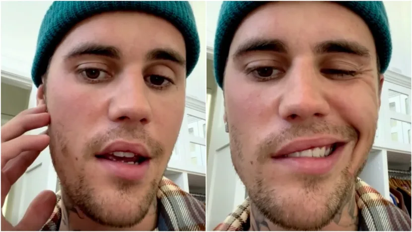 Artisten Justin Bieber drabbades nyligen av Ramsay Hunts syndrom. På Instagram visade han upp sin ansiktsförlamning och berättade att han behövde ställa in sina uppträdanden. Foto: Justin Bieber/Instagram