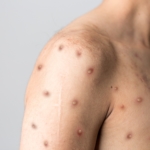 Apkoppor (mpox): symtom, orsak & behandling