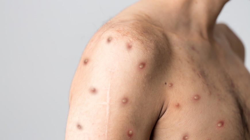 Apkoppor ger vätskefyllda och kliande blåsor i huden.  Foto: Shutterstock