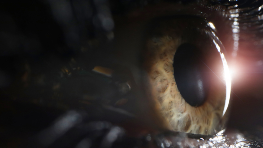 Retinaldystrofi är en ärftlig ögonsjukdom. Nu har första genterapibehandlingen för sjukdomen genomförts i Sverige.  Foto: Shutterstock