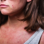 Nya behandlingar ger hopp vid måttlig och svår atopisk dermatit