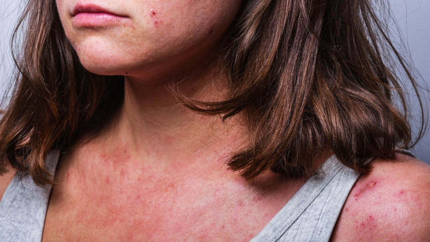 Atopisk dermatit hos barn och vuxna kan påverka och begränsa livet och livskvaliteten Foto: Shutterstock