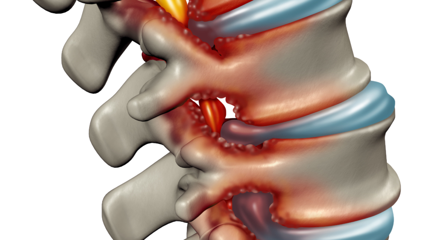 Vid spinal stenos har kanalen mellan ryggkotorna blivit trång, och nerver hamnar i kläm.  Foto: Shutterstock