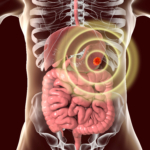 GIST – gastrointestinal stromacellstumör