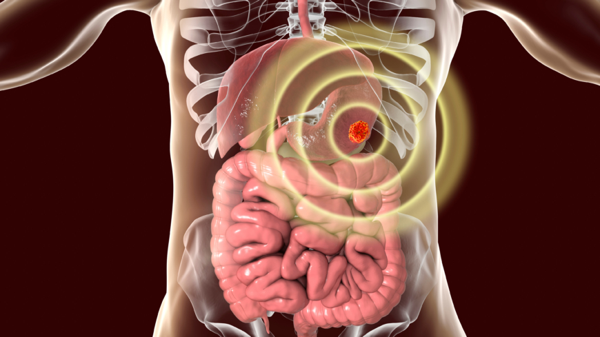 GIST, gastrointestinal stromacellstumör, sitter oftast i magsäcken, men kan drabba andra delar av tarmsystemet.  Foto: Shutterstock