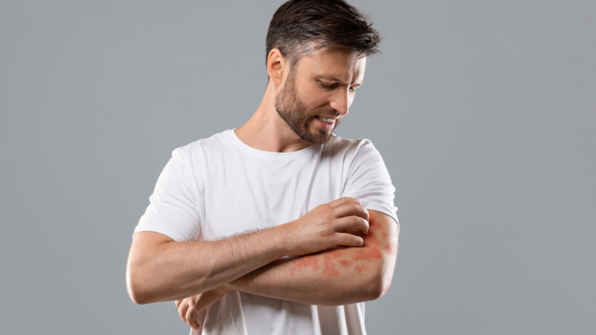 Eksem beror på en inflammation i huden. Symtomen är torr hud, rodnad och klåda.  Foto: Shutterstock