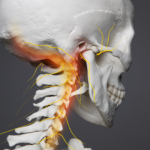 Cervikobrakialt syndrom: symtom, orsaker och behandling