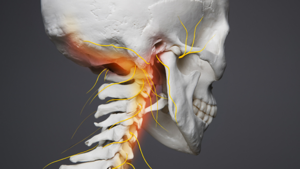 Cervikobrakialt syndrom: symtom, orsaker och behandling