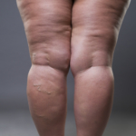 Rapport om lipödem: Forskning kring diagnostik och behandling viktigast