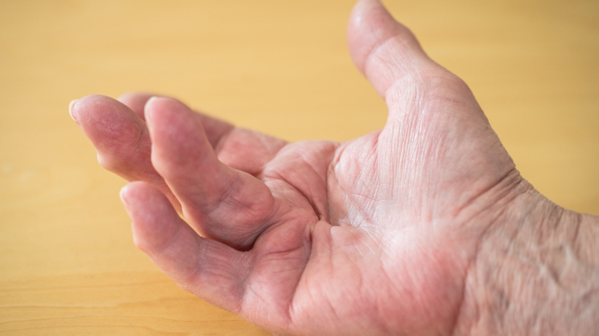 Dupuytrens kontraktur leder till att ett eller flera fingrar fastnar i böjt läge. Foto: Getty Images