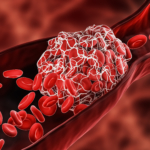 Antifosfolipidsyndrom (APS)