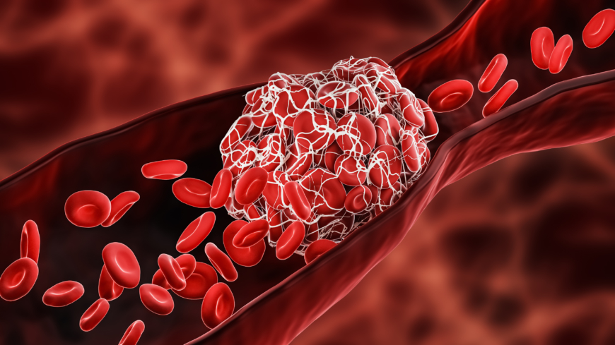 Blodpropp är det vanligaste symtomet vid antifosfolipidsyndrom, och kan drabba både artärer och vener.  Foto: Getty Images