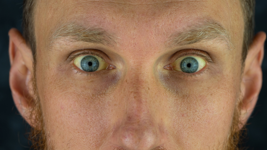 Vid Gilberts syndrom leder höga bilirubinnivåer i blodet till att hud och ögonvitor kan bli lätt gulfärgade.  Foto: Getty Images
