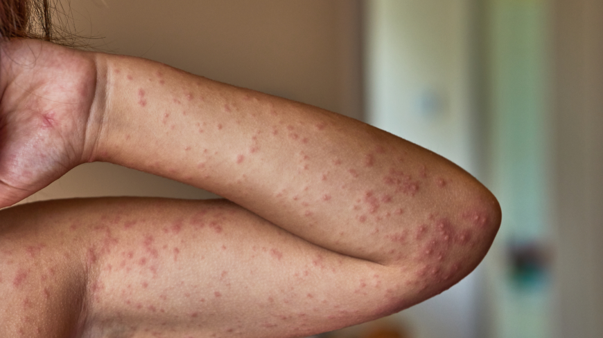 Atopisk dermatit är en inflammatorisk hudsjukdom som ger torr hud och kliande eksem. Foto: Getty Images