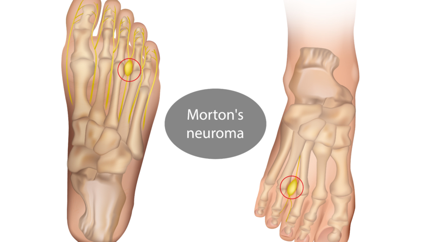 Mortons sjukdom kallas även Mortons metatarsalgi eller neurom. Trängsel mellan två mellanfotsben trycker på nerven mellan dem och ger smärta och inflammation. Foto: Getty Images