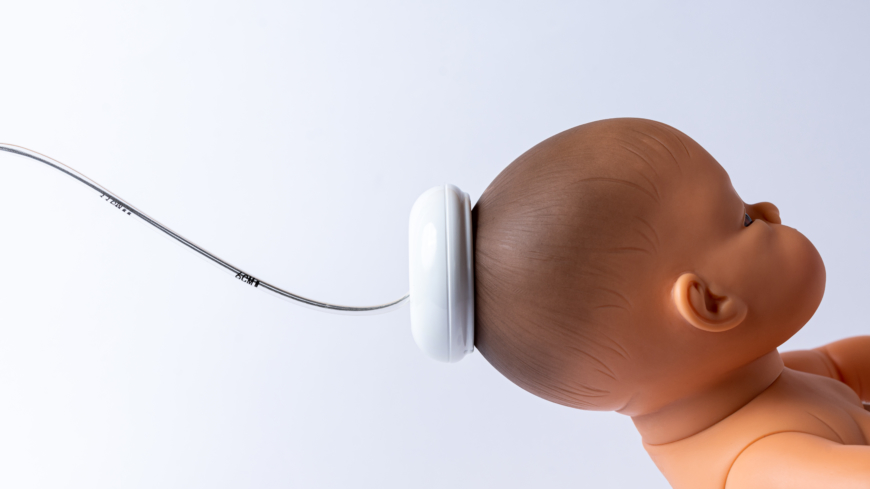 Sugklocka används ibland vid födsel för att snabba på barnets utdrivning. På den här bilden visar hur en sk Kiwiklocka anlagts på barnets huvud.  Foto: Getty Images