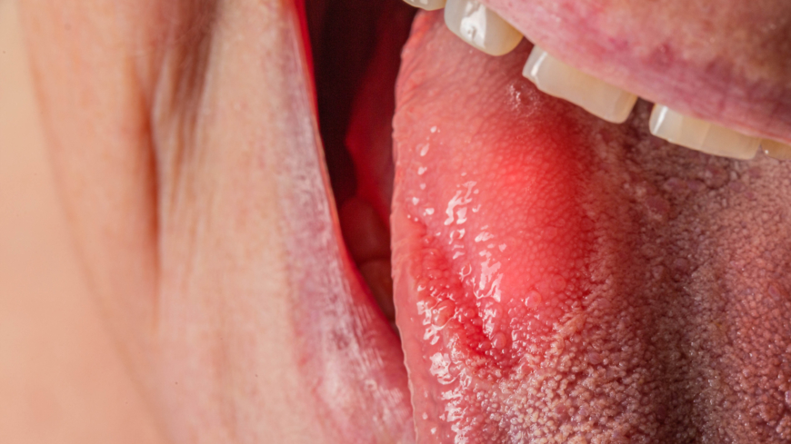 Vid glossit blir tungan röd och ömmande. Ofta finns också en beläggning på tungans yta.  Foto: Getty Images