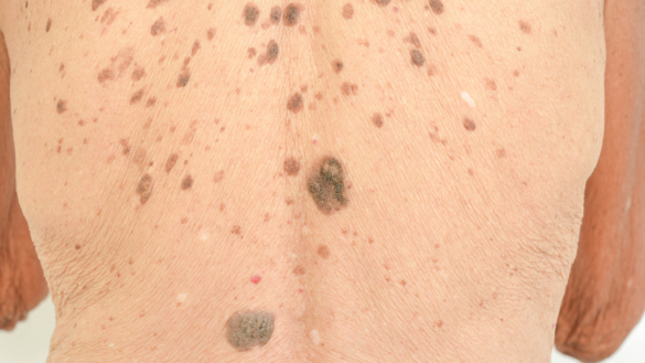 Åldersvårta (mjällvårta, seborroisk keratos): orsak, symtom & behandling