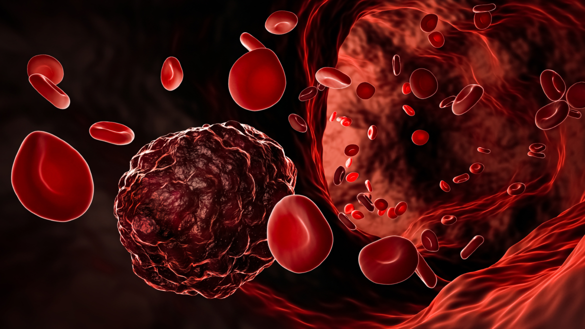Akut lymfatisk leukemi (ALL) – orsak, behandling & prognos