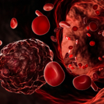 Akut lymfatisk leukemi (ALL) – orsak, behandling & prognos