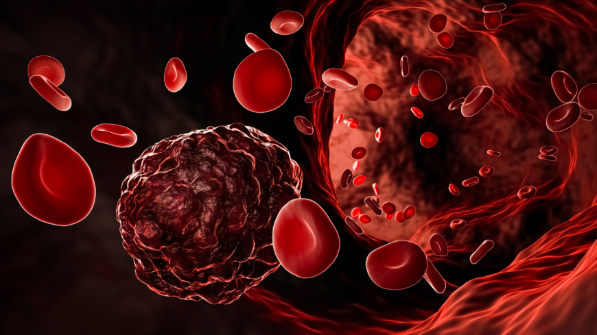 Vid akut lymfatisk leukemi får man brist på röda och vita blodkroppar samt blodplättar. Foto: Getty Images