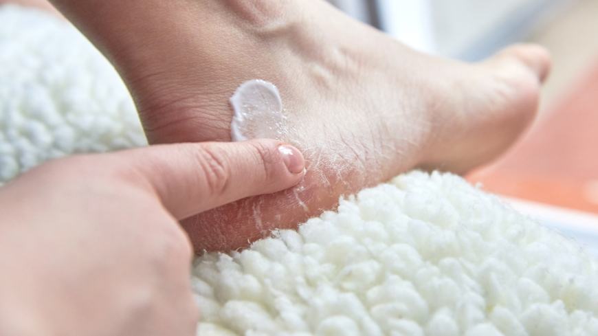 Vid hälsprickor kan det hjälpa att smörja in fötterna regelbundet med mjukgörande.  Foto: Getty Images