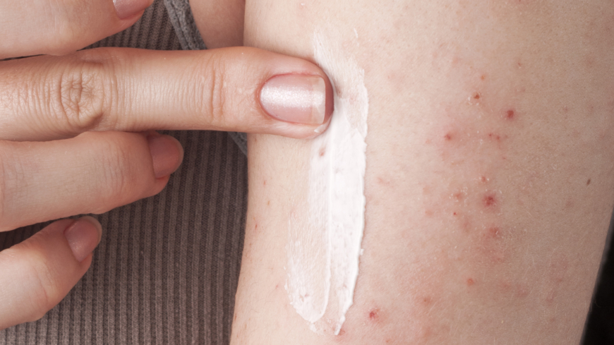 Att smörja in huden regelbundet varje dag vid hudsjukdomen keratosis pilaris är grundbehandingen. Foto: Getty Images