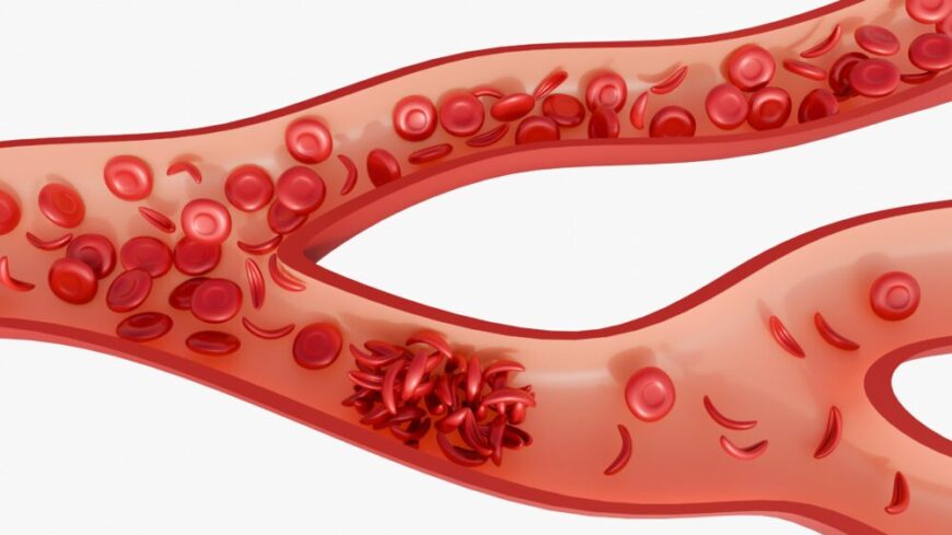 Den kroniska smärta och trötthet som många gånger följer av sicklecellanemi, gör det svårt för många att klara av sitt arbete. Foto: Getty Images