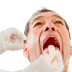 Halsböld (peritonsillär abscess): orsak, symtom & behandling