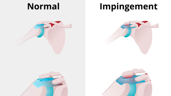 Impingement i axeln: orsak, symtom & behandling