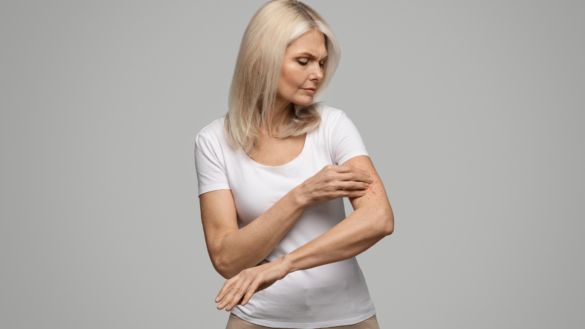 Prurigo nodularis: orsak, symtom & behandling