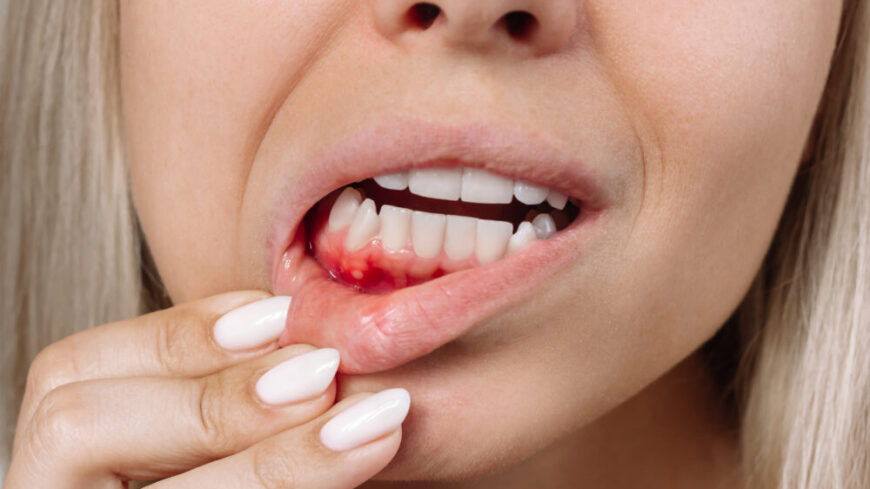 Inflammationer till följd av vitt snus kan i värsta fall ta år att läka. Foto: Getty Images