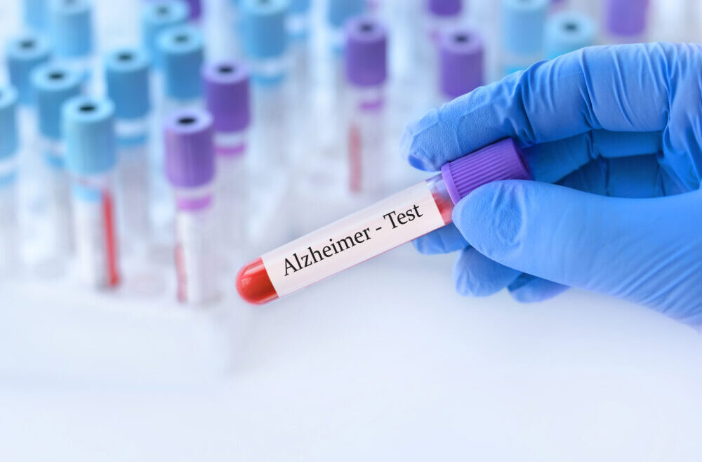 Alzheimers sjukdom: blodtest för tidig upptäckt
