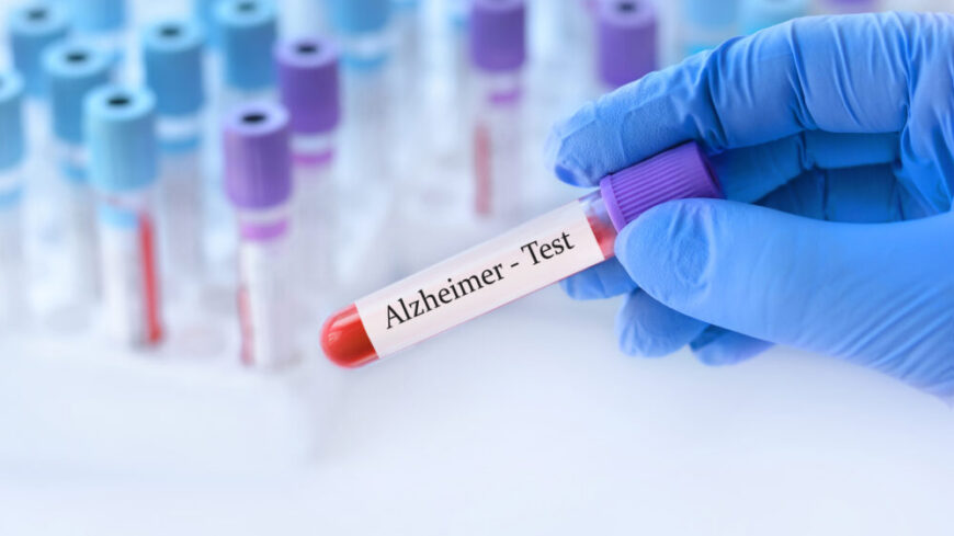 Blodtest som identifierar Alzheimers sjukdom har hög träffsäkerhet. Foto: Getty Images