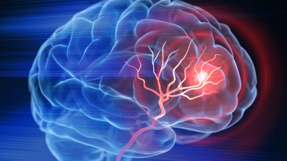 TIA – orsak, symtom & behandling